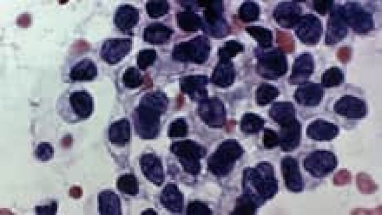 A photomicrograph of cancerous cells detected by a Pap test. 