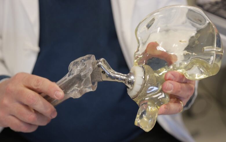  A doctor holds a model of a cementless hip replacement.