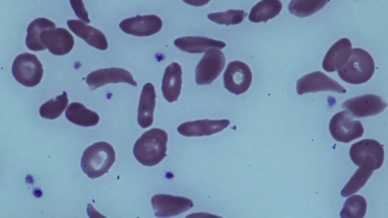 Red blood cells affected by sickle cell disease.