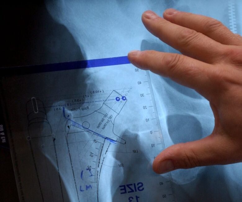 An x-ray of a hip with a person's hand holding a template up against it