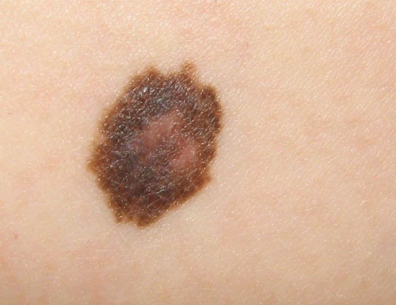 A melanoma spot.