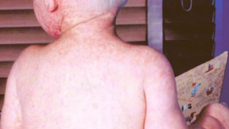 The bare back of a young child, covered with a red rash.