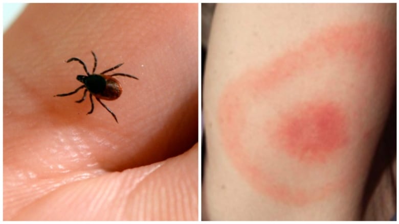 A blacklegged tick and a bite mark