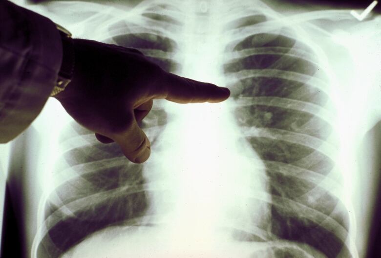 Finger points at an x-ray of a lung