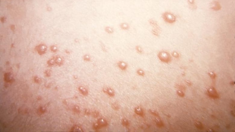 Close up view of shingles rash.