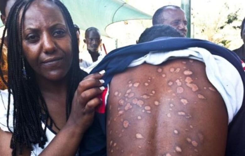 A woman holds up a man's shirt to show wounds on his back.