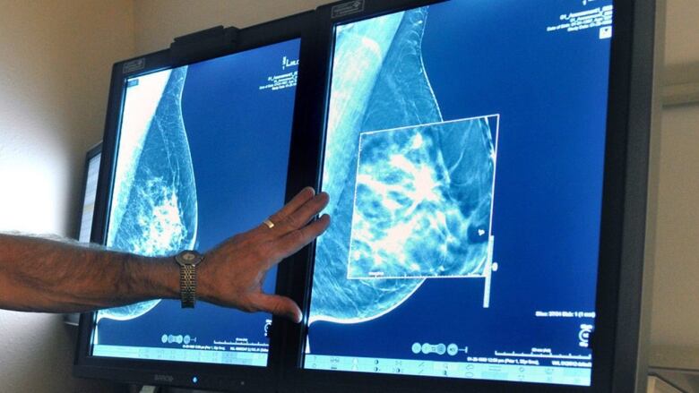 a hand pointing to a computer screen showing a mammogram