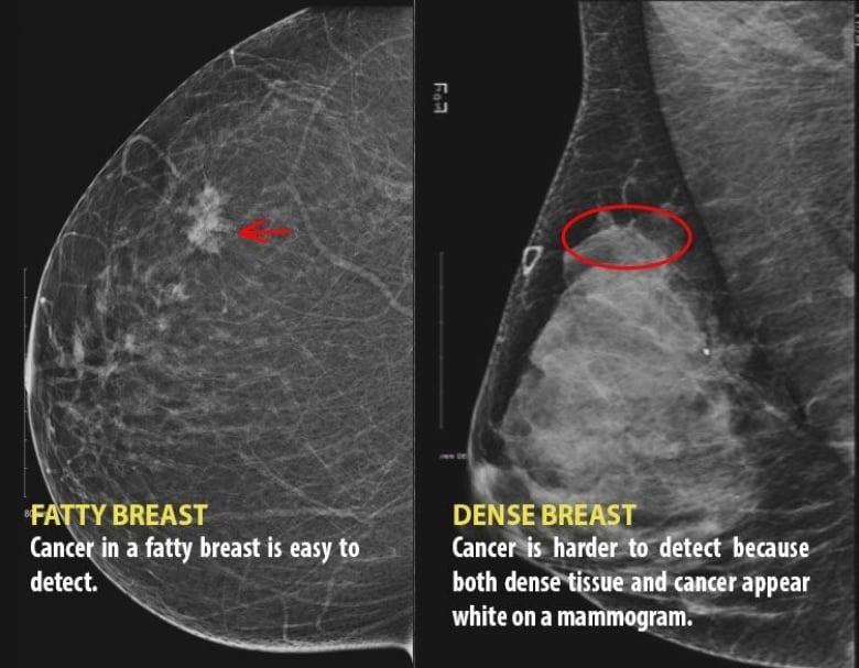 X-rays of two breasts. The one on the right has more white in the image which is obscuring a tumour that also appears white.