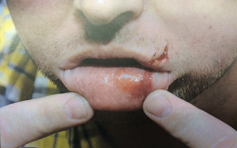 A police evidence photo of a man's busted lip.