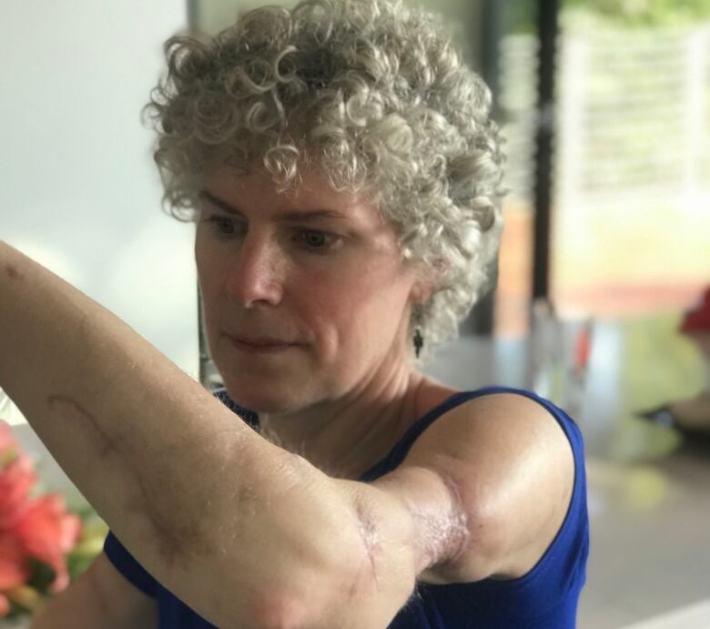 A woman holds up her arm which is covered in scars