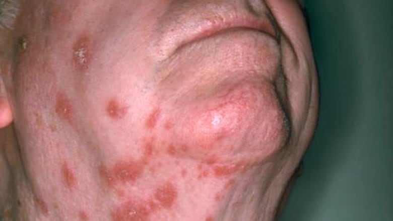 A photo of an older man's lower face and neck shows a shingles rash. The rash is clusters of red blisters with scabs forming.