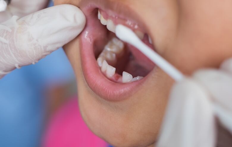 A closeup shot of a child's mouth is shown, with gloved hands rubbing a Q-Tip over teeth.