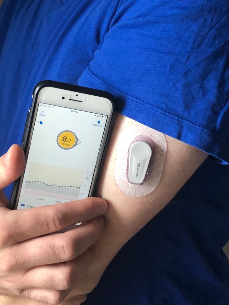 Continuous Glucose Monitor on arm