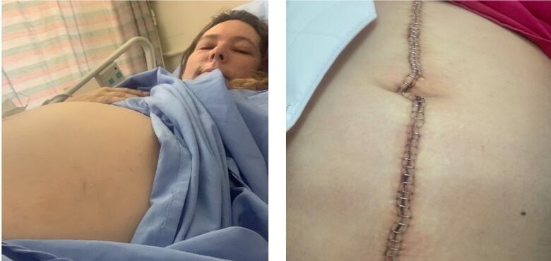 Photos show Cheryl-Anne Labrador-Summers with a distended stomach before her emergency surgery (left) and the 55 staples along her torso following the procedure (right).