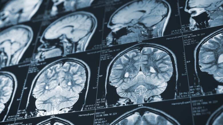 Close up series of a CT scan with human head on it. X-ray medicine concept.