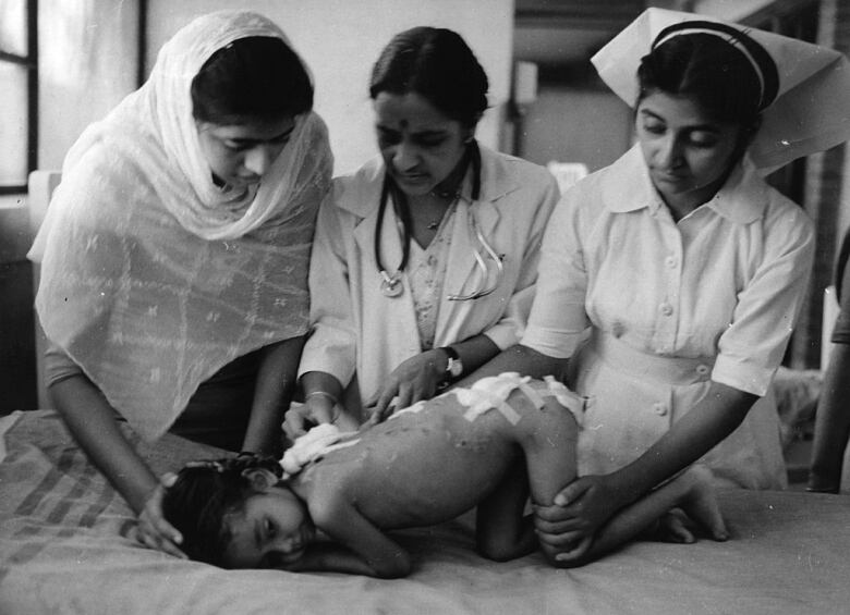 A doctor in the middle and two nurses by her side are treating a naked child on a hospital bed. The child is head down on the bed and has bandages on the body. This is a black and white picture. 