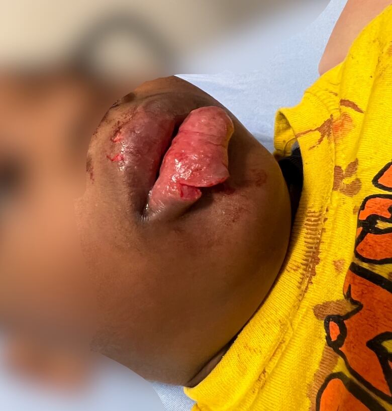 Young boy's lower lip appears to be cut and torn.