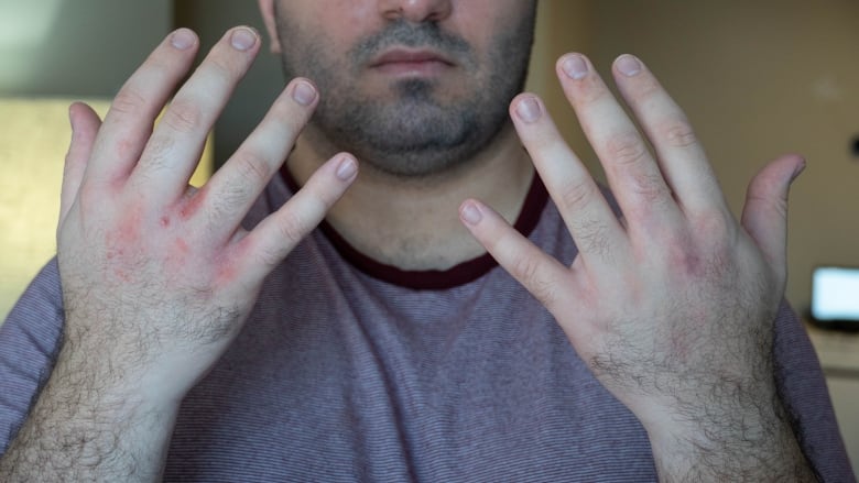 A man shows the rash on his hands, which he believes resulted from an allergic reaction to a COVID vaccine.