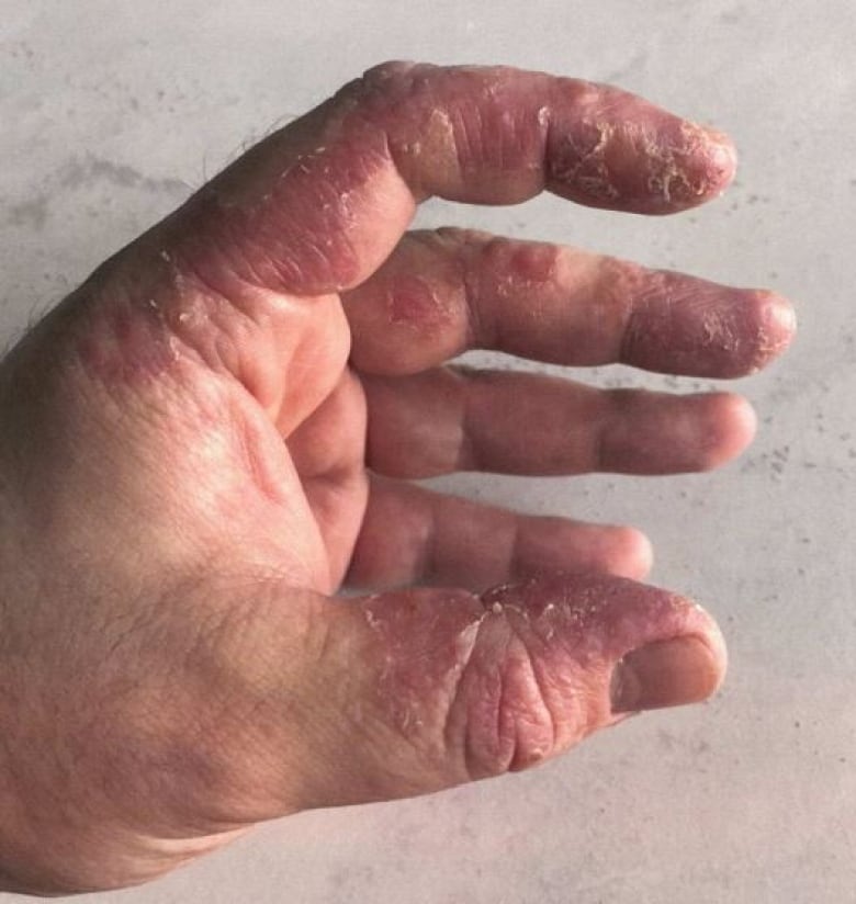 A man's hand with severe blistering eczema.