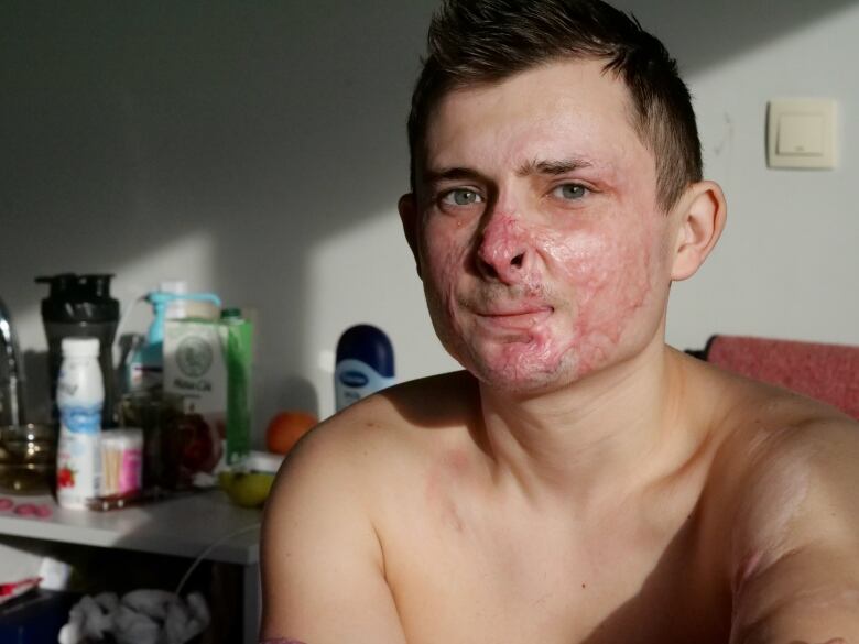 A man with burn wounds looks into the camera.