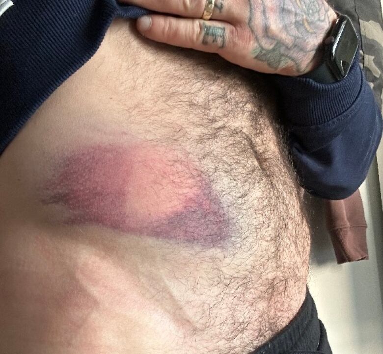 A man lifts his shirt to show a massive bruise on his stomach caused by a less-lethal round fired by Vancouver police.