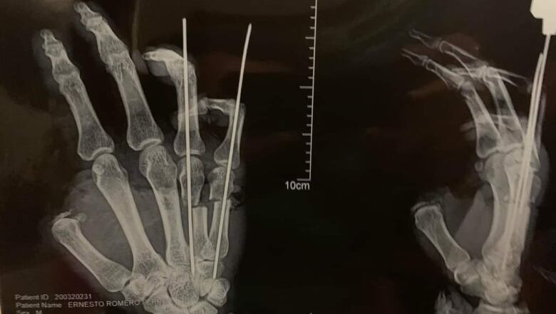 Black and white x-ray of two hands.