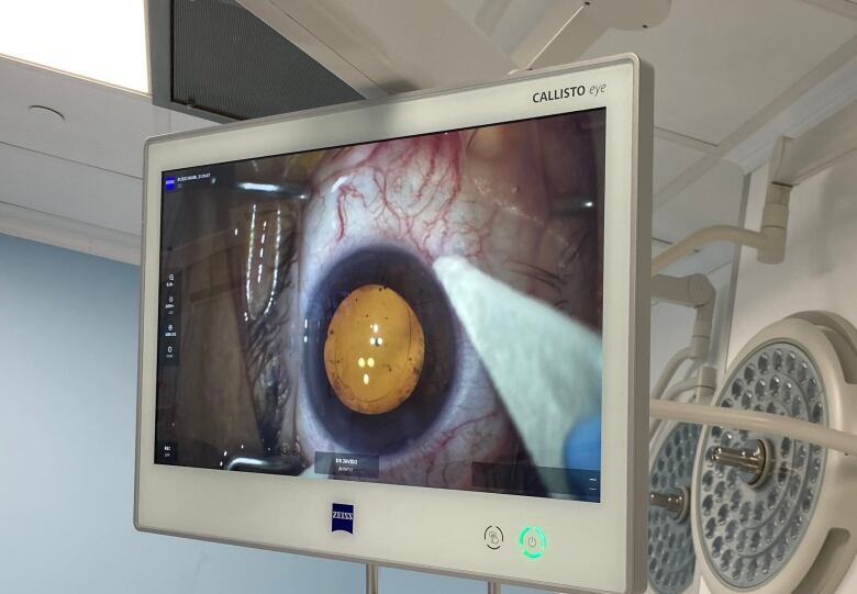 An extreme closeup of a person's eyeball shown on a monitor during eye surgery.