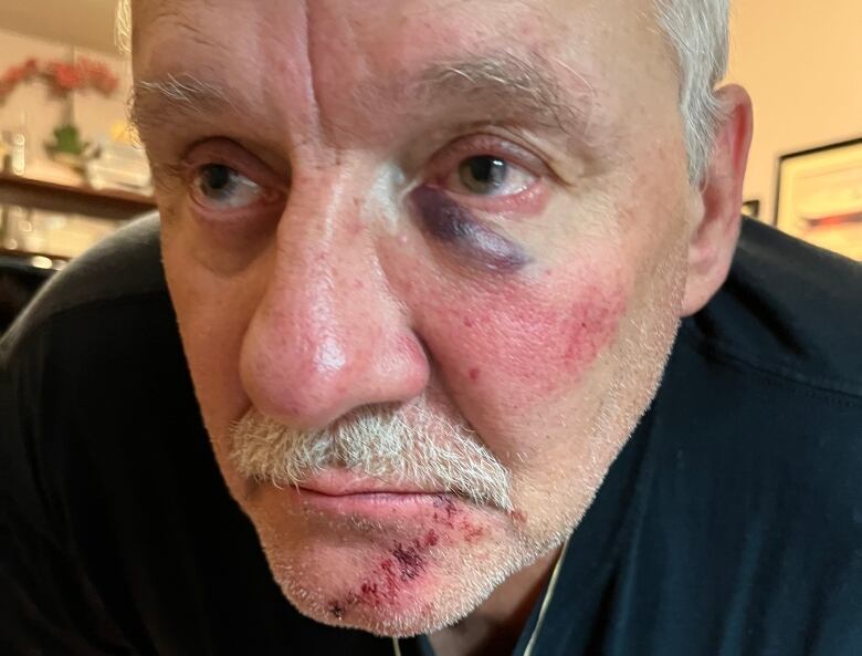 A man leans into the camera to show a bruised eye and scrapes on his chin.