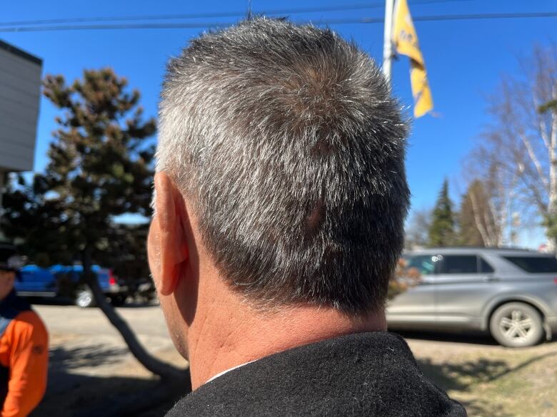 Graying hair on a mans head from behind, a scar is visible through the hair