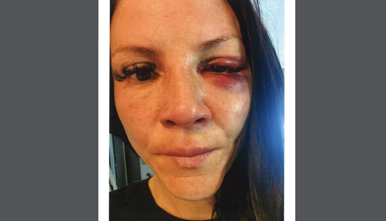 Front view of a woman with a bruised eye, nearly swollen shut.