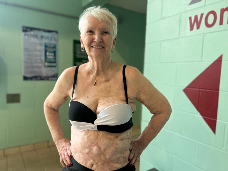 Debbie Ward poses with her hands on her hips and a gentle smile while she wears a two piece black and white bathing suit, exposing the scars on her stomach she's hidden for 60 years. 