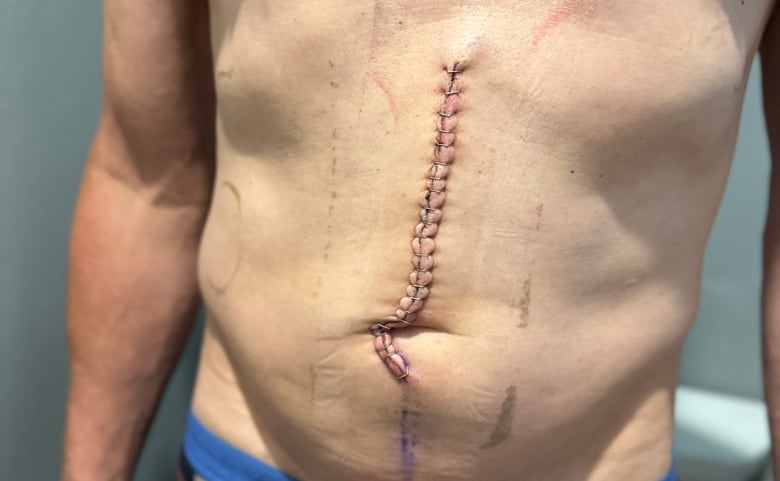 A line of staples is seen going down a man's belly, from his sternum to blow his belly button. 