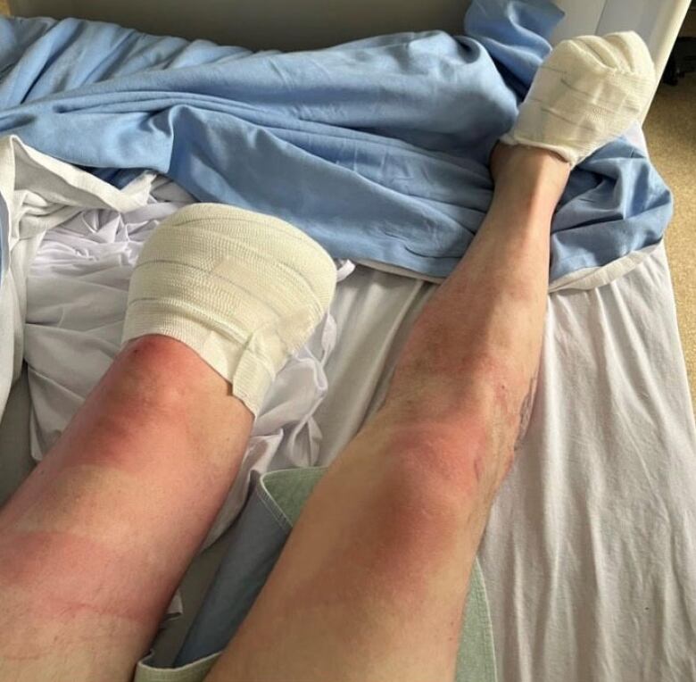 A closeup of a man's legs on a hospital bed, the left one amputated and bandaged below the knee, and half of his right foot amputated and bandaged.