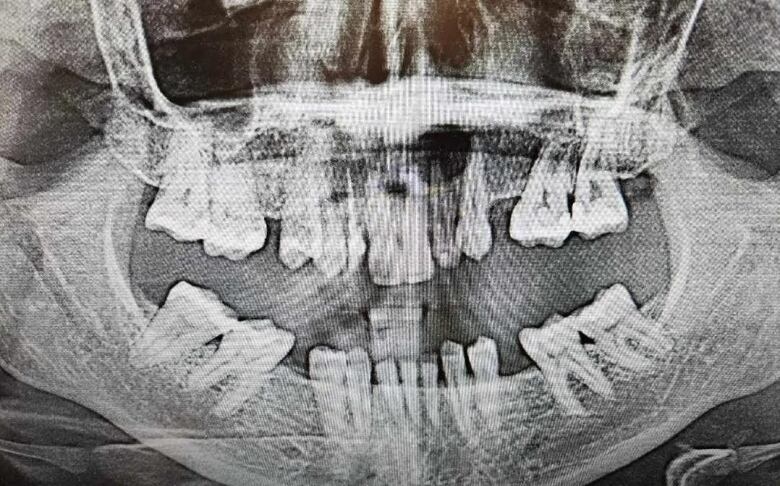 An x-ray image of teeth