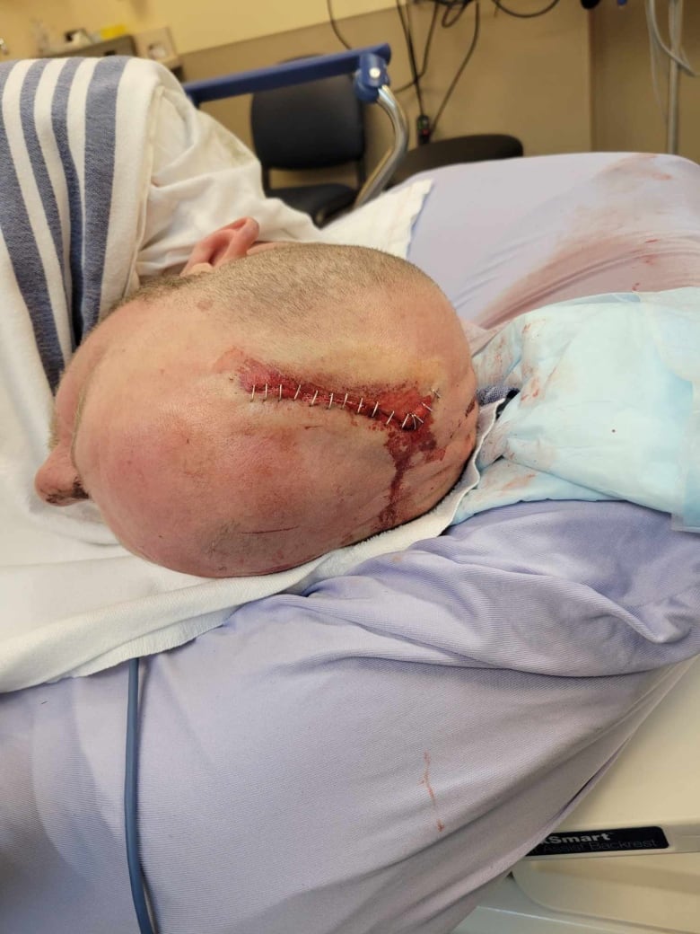 A bald man lies in a hospital bed, a large head wound with several stitches is visible with some dried blood.