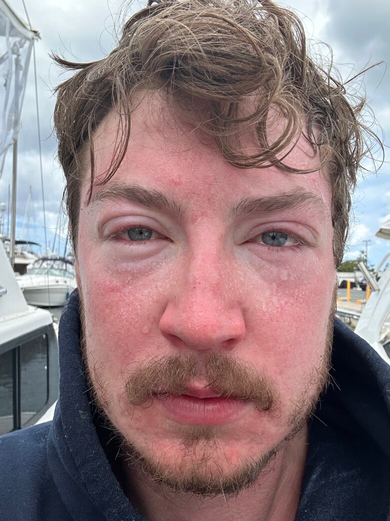 A man's eyes are swollen in a selfie