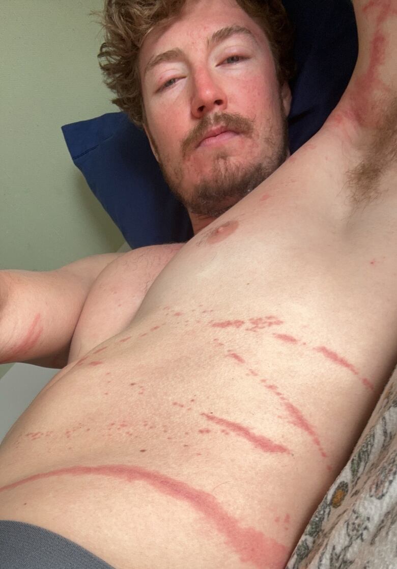 A man shows off long scars along the side of his bare chest.