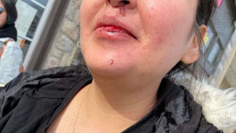 A woman's bloodied lip is pictured.