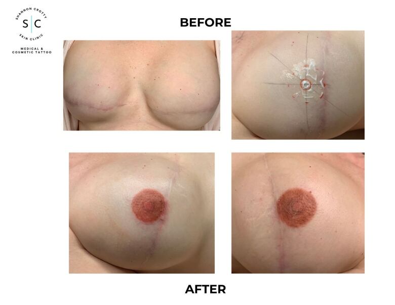 Two pictures depict breasts without nipples, two others depict breasts with paramedical tattoos mimicking the appearance of nipples.