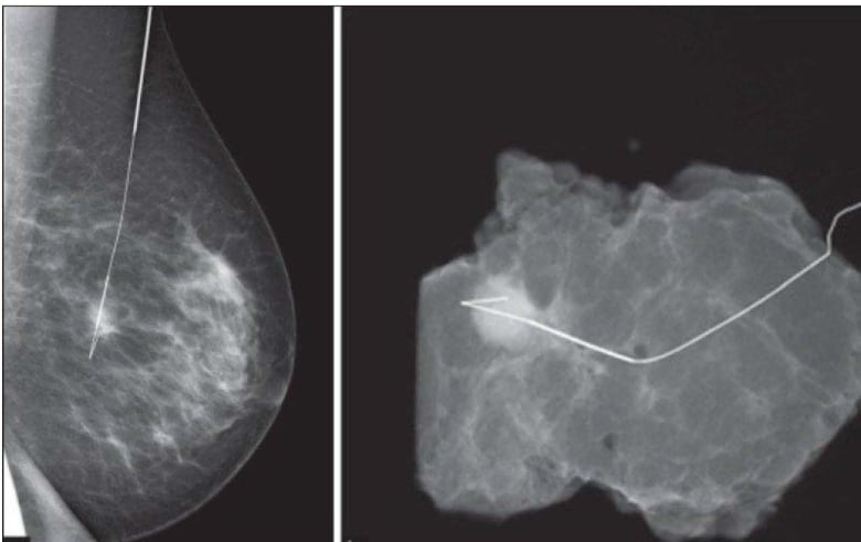 Photo shows hook wire in breast tissue