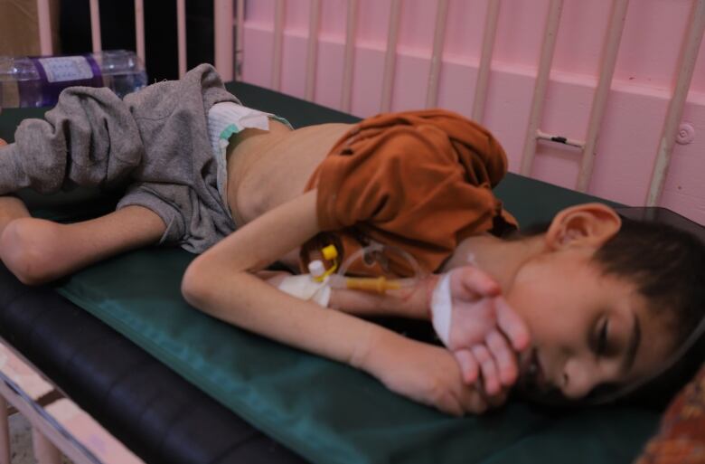 An emaciated child lies on a hospital bed.