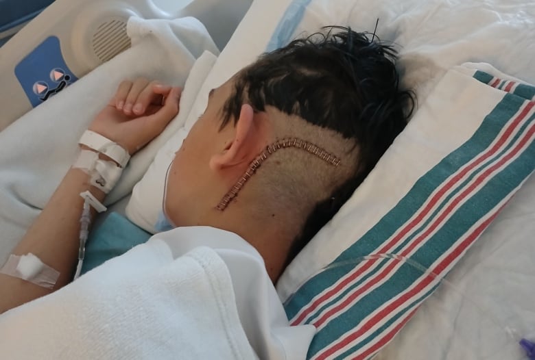 A boy with multiple staples in his head, lays in a hospital bed. 