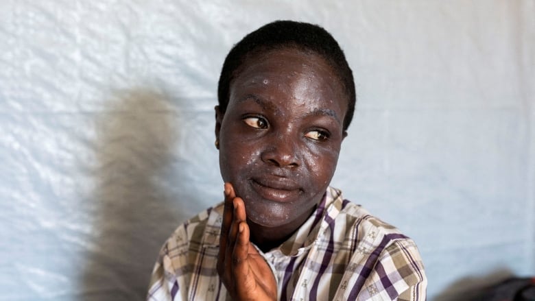 Sylvie Nyota,14, applies medication to her skin as she undergoes treatment against Mpox, in Munigi, Nyiragongo territory, near Goma in North Kivu province of the Democratic Republic of Congo.