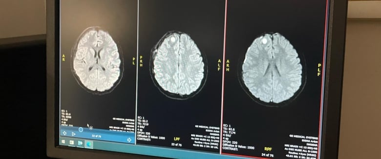 Three black and white brain scans are pictured side by side. A white ball about the size of blueberry can be seen at the top left corner of two scans.