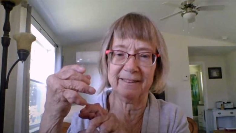 A woman with short hair and glasses, sitting in a living room, holding up her hands, twisted by rheumatoid arthritis.