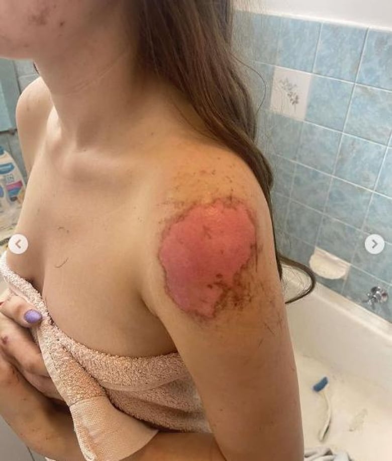 A woman with anabrasion on her shoulder